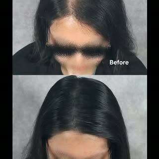 응, 이 사진 올릴 때 영어로 이렇게 했었어:

“After giving birth, our client continued to struggle with hair loss and 