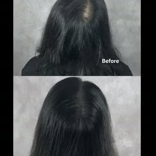 응, 이 사진 올릴 때 영어로 이렇게 했었어:

“After giving birth, our client continued to struggle with hair loss and 