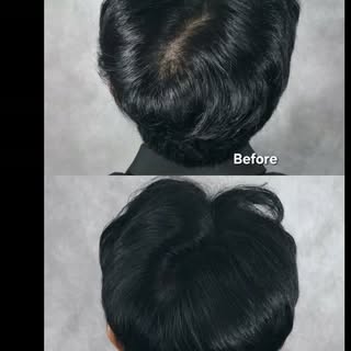 A groom in his 30s, soon to be married, finally decided to get the SMP treatment he had been conside
