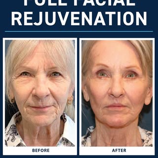 This incredible transformation was achieved through a comprehensive Full Facial Rejuvenation plan de