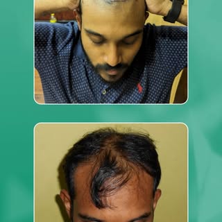 The feedback of Dr. Anindya Goutam after geting hair transplant treatment from our clinic -PLCSC. 

