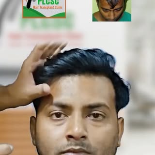 The feedback of Mr. Monojit after getting hair transplant treatment from our clinic - PLCSC.

[Best 