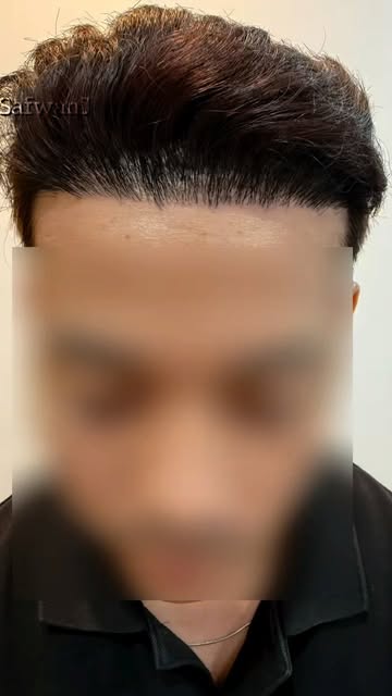 “Nampak tak apa yang pelik dengan hairline ni?”

Patient ni buat hair transplant sekitar Oktober 202