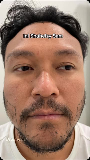 “Bukan semua spot yang tak grow selepas beard/hair transplant bermaksud graft tak menjadi.” 👀

This