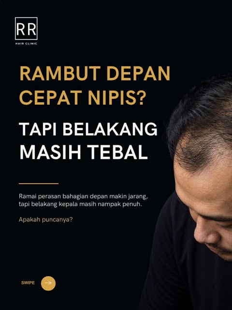 Rambut depan makin nipis, tapi belakang masih tebal? 

Ini boleh jadi antara tanda awal pattern hair