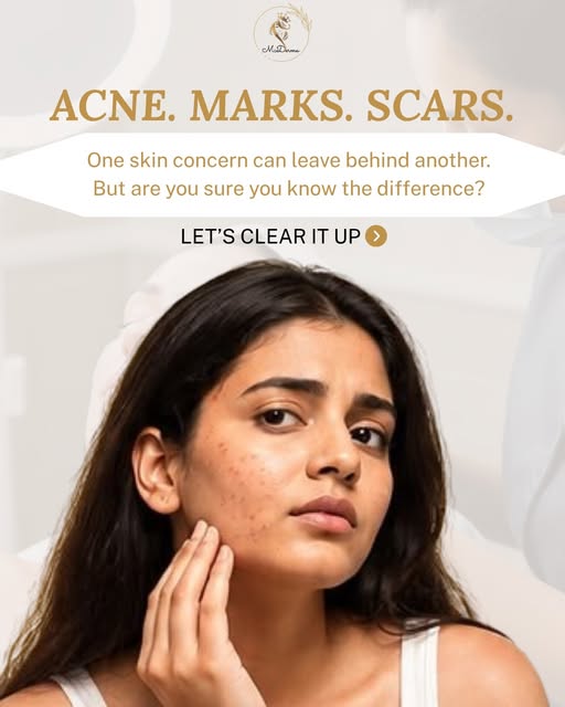 Still calling every skin concern “just acne”? Let’s clear that up. 👀✨

Active acne, acne marks and 