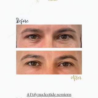 Tired, puffy eyes? This client came to us looking for a long-term solution, not a quick fix.

After 