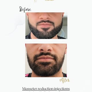Masseter Botox for a slimmer, more contoured jawline 💉✨
This client wanted to soften a bulky lower 