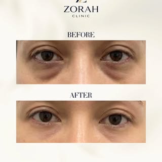 Subtle under-eye rejuvenation with polynucleotides ✨

This treatment works by improving skin quality