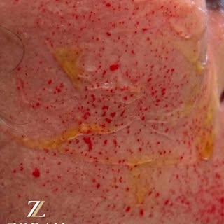 PRP microneedling in action ✨
Microneedling creates controlled micro-channels in the skin, while PRP