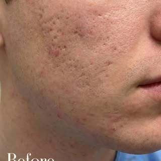 Real results, real skin regeneration 👇
This is the journey of PRP microneedling for acne scarring a