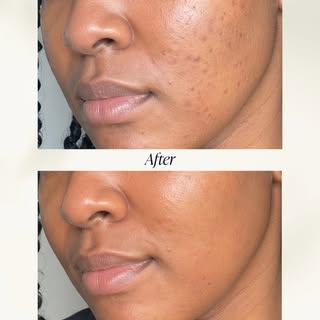 Progress, not perfection.

This before and after shows the improvement following a course of PRP ski