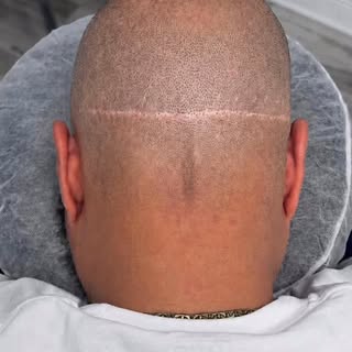 Not every scar disappears.Some are strategically rewritten. ⚡️

Scar camouflage is controlled balanc