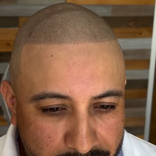 Poetry in motion. Watch me edge up that hairline one dot at a time ⚫️ @scalpmicro_usa 
#scalpmicropi