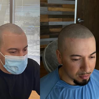 New hairline🟰 New confidence 💫

⚫️@folicule #8 level dilution 

 @scalpmicro_usa 

#scalpmicropigm