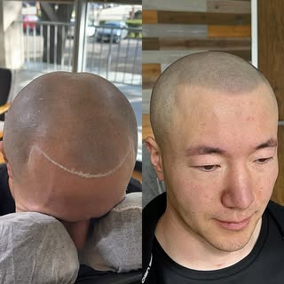 No more thinning and No more hiding 🚫🧢 

@scalpmicro_usa 
@folicule 

#scalpmicropigmentation #sca