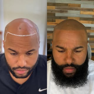 The beard + hairline looking meannn 🔥 

@graigscalpmicro in Houston, TX 

#smp #hairtattoo #scalpta