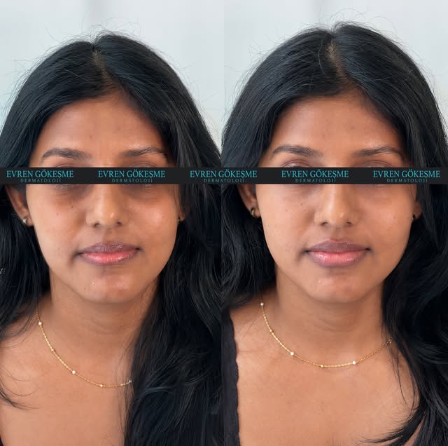 A natural touch to the lips and under-eye area ☺️👌
#lipfiller #teartroughfiller #curvylips💋💋💋 

