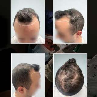 This patient underwent a hair transplant focusing on the frontal, midzone and crown. The one day pro