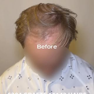 This patient underwent a two day hair transplant focusing on the frontal, midzone and crown. The two