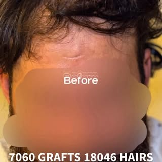 This patient underwent a two day hair transplant focusing on the frontal, midzone and crown. The two
