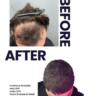 12 MONTHS TRANSFORMATION

This patient had completely lost their frontal hairline and thinned throug