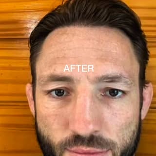 12 MONTHS TRANSFORMATION

Hair restoration goes beyond graft numbers. It involves artistic design, s