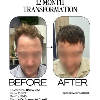 12 MONTHS TRANSFORMATION

Have a look at these results - Frontal, mid zone and crown thinning all ad