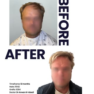 This patient underwent a two day hair transplant focusing on the frontal, midzone and crown. The two