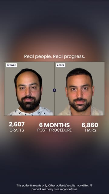 At 6 months, this is the patient’s progress. 2,607 grafts, 6,860 hairs placed along the frontal hair