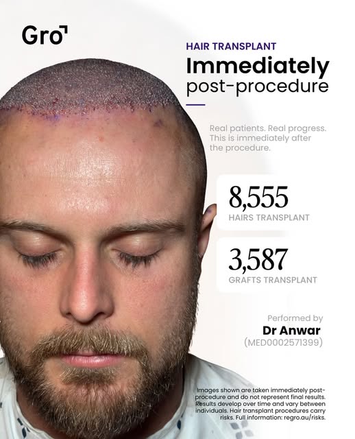 This is what one day at Gro Clinics looks like.

3,587 grafts and 8,555 hairs, placed one at a time 