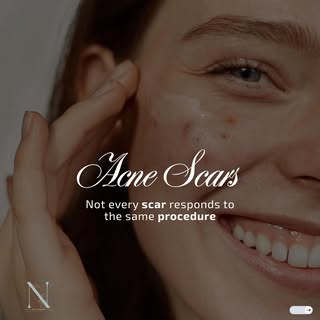 Not every acne scar is the same—and that’s why every acne scar treatment should be personalized.

Di