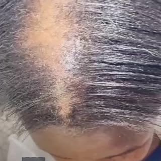 Witness the stunning transformation from hair loss to hair gain. Unleash your confidence with our ex