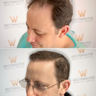 This gentleman was a Norwood 3 and had an FUE hair transplant totalling 2,071 grafts.

To book a con