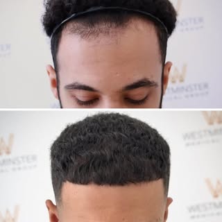 1,484 grafts. A restored hairline. A result that speaks for itself.

FUE hair transplantation at Wes