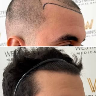 This gentleman had an FUE hair transplant totalling 1,156 grafts to restore his frontal hairline. To