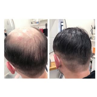 Kim candy , Men’s hairloss replacement @ Florescence Aberdeen