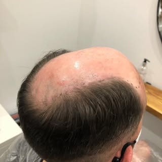 Kim candy @Florescence , Aberdeen - Men’s hair replacement before and after