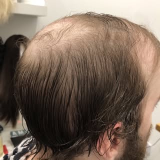 Another transformation today , Mens Hairloss System , before and after