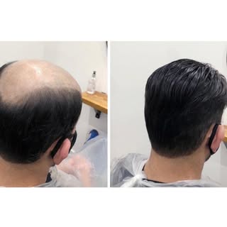 Too all men, stressed out with Hairloss, Kim Candy@Florescence, over 37yrs experience in Hairdressin