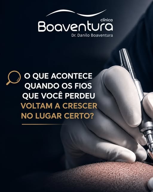 O transplante capilar não é apenas sobre recuperar fios. É sobre recuperar confiança.
Muitas pessoas