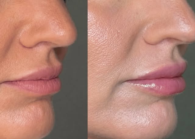Subtle enhancement. Beautiful definition. Still completely you. ✨

Natural lip enhancement is all ab