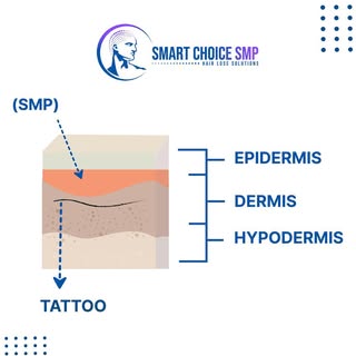 Scalp Micro Pigmentation (SMP) and tattoos are similar in that they both involve depositing pigment 