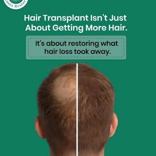 Hair transplant isn’t just about adding more hair. It’s about creating a result that looks natural, 