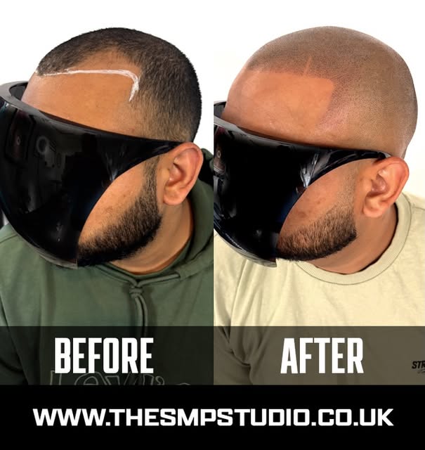 Most recent transformation on a man with a receding hairline.
•
🌟 Discover the Transformational Pow