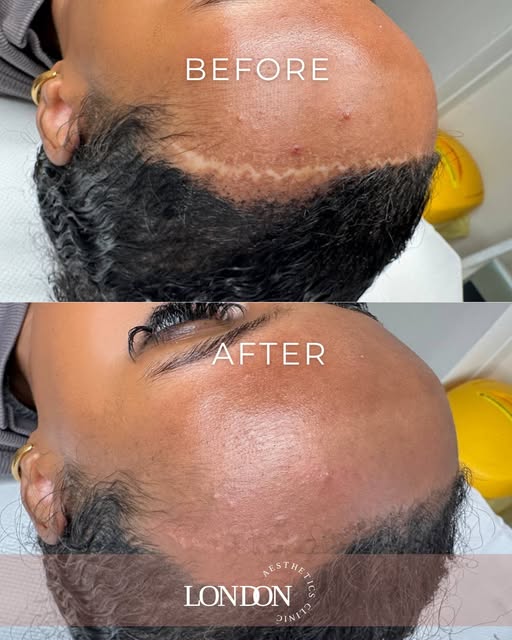 Scar Camouflage — First Session

An incredible improvement after just one session of scar camouflage