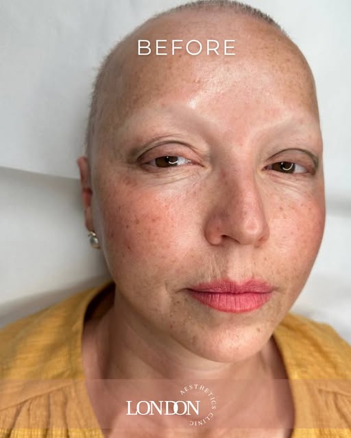 Cancer Patient Eyebrow & Eyelash Transformation

An incredible before and after following eyebrow an