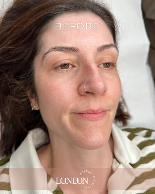 Brows that look like real brow hairs — not tattooed on.

Take a look at this beautiful nanoblading t