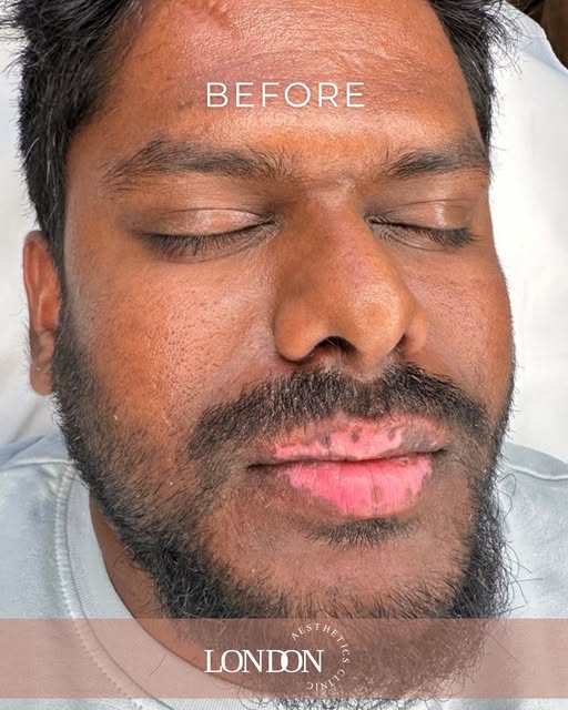 Lip Vitiligo Camouflage – After 1 Session

An incredible improvement after just one session of lip v
