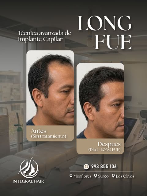 𝗥𝗲𝘀𝘂𝗹𝘁𝗮𝗱𝗼𝘀 𝗾𝘂𝗲 𝗵𝗮𝗯𝗹𝗮𝗻 𝗽𝗼𝗿 𝘀𝗶́ 𝘀𝗼𝗹𝗼𝘀 🔍

La 𝘁𝗲́𝗰𝗻𝗶𝗰𝗮 𝗟𝗢𝗡𝗚 𝗙�